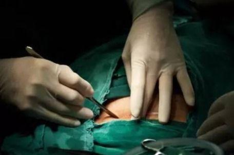 剖腹产视频,直观呈现母婴安全守护