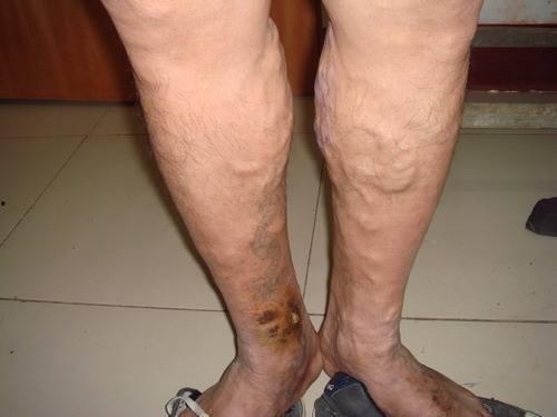 静脉曲张症状图片,识别与预防的关键