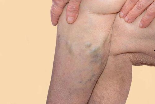 静脉曲张症状图片,识别与预防的关键