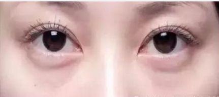 下眼睑浮肿图片,成因与改善之道