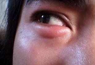 下眼睑浮肿图片,成因与改善之道