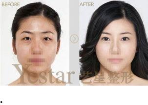 韩国艺兴整容,揭秘明星蜕变之路