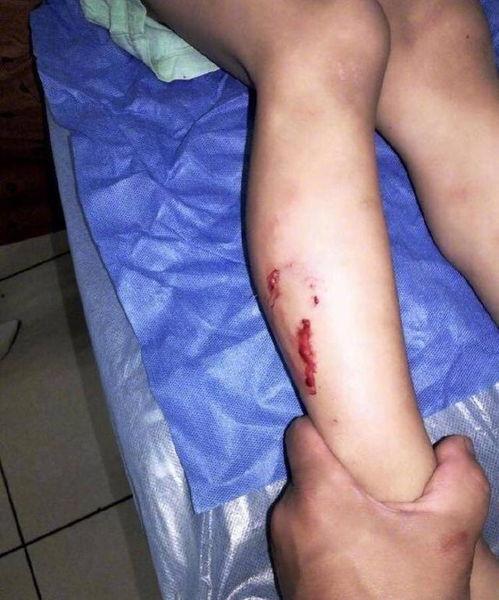 狗咬伤图片,紧急应对与预防措施解析