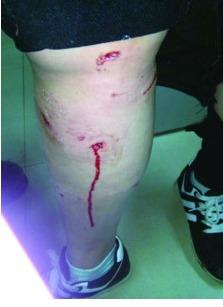 狗咬伤图片,紧急应对与预防措施解析