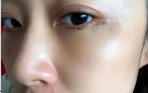 外切眼袋手术疤痕图片,术后恢复与护理要点