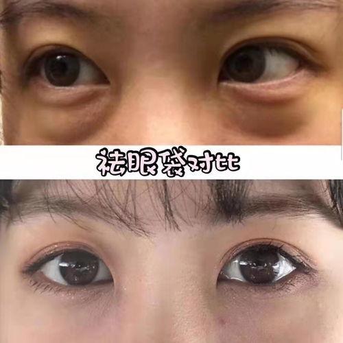 外切眼袋手术疤痕图片,术后恢复与护理要点