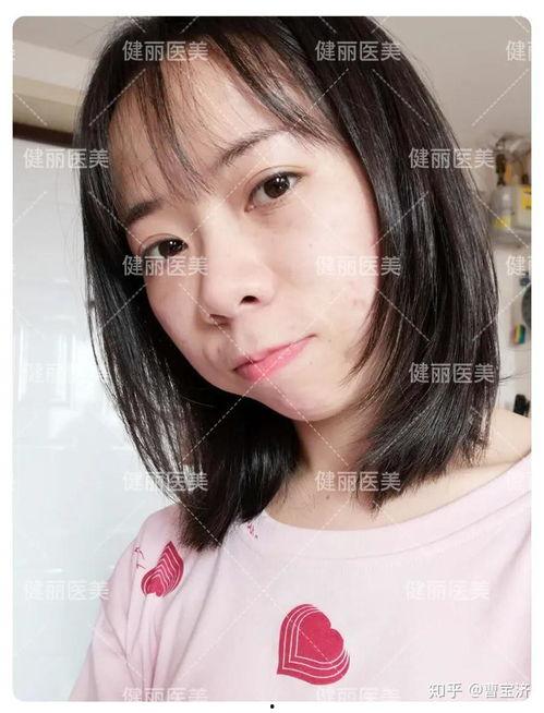 外切眼袋手术疤痕图片,术后恢复与护理要点