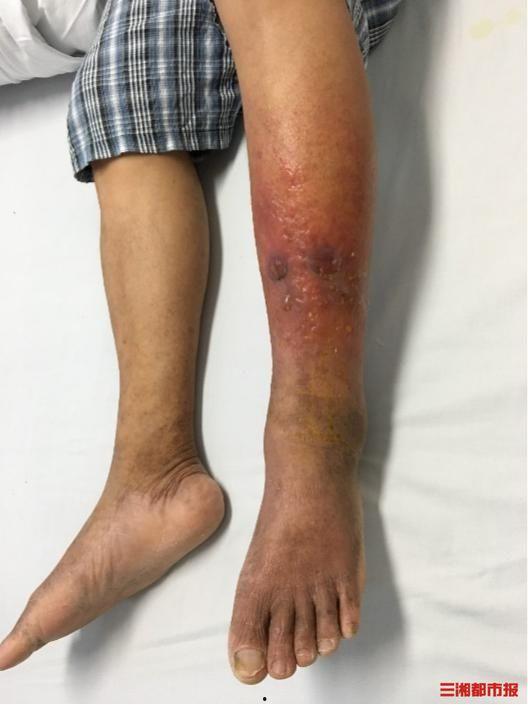 烂脚图片,揭秘脚部健康问题与防治策略