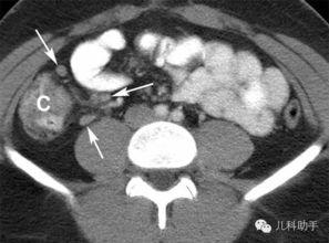 新生儿淋巴结图片大全,全面了解宝宝健康指标