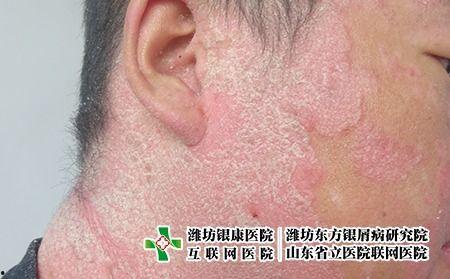 腋下癣图片,图片解析与防治要点