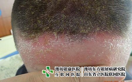 腋下癣图片,图片解析与防治要点