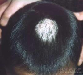 腋下癣图片,图片解析与防治要点