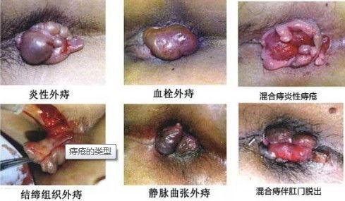 外痔疮的图片,症状与预防要点