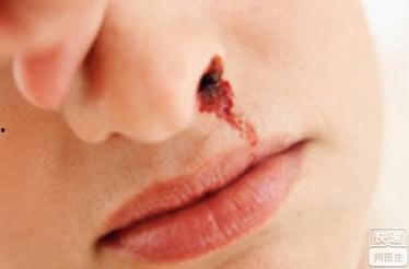 口周炎的症状和图片,从图片看口腔健康警示