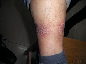 脂膜炎图片,揭秘皮下脂肪炎症的病理特征与诊断要点