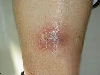 脂膜炎图片,揭秘皮下脂肪炎症的病理特征与诊断要点