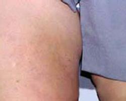 脂膜炎图片,揭秘皮下脂肪炎症的病理特征与诊断要点